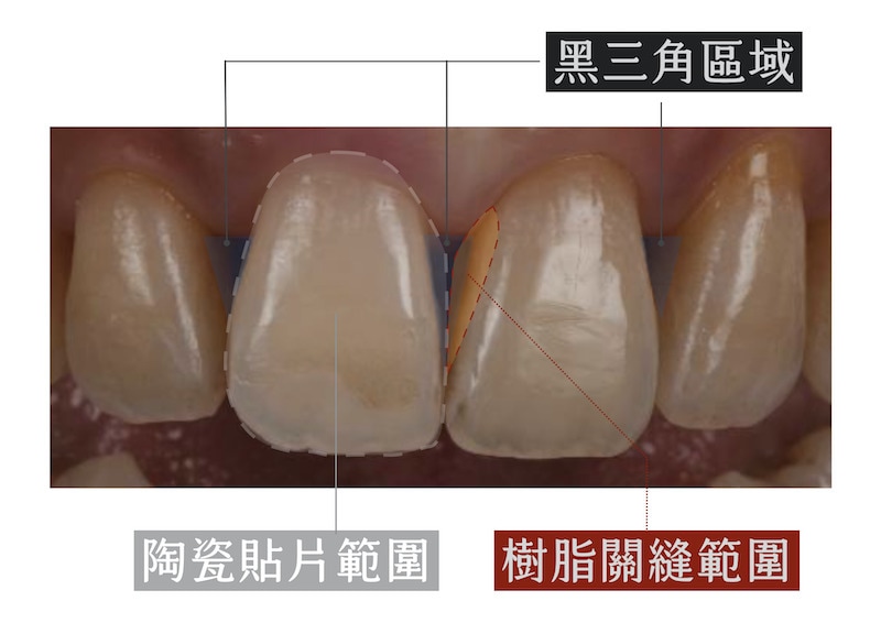陶瓷貼片-牙縫黑三角-樹脂填補與陶瓷貼片範圍比較-台中-吳國綸醫師