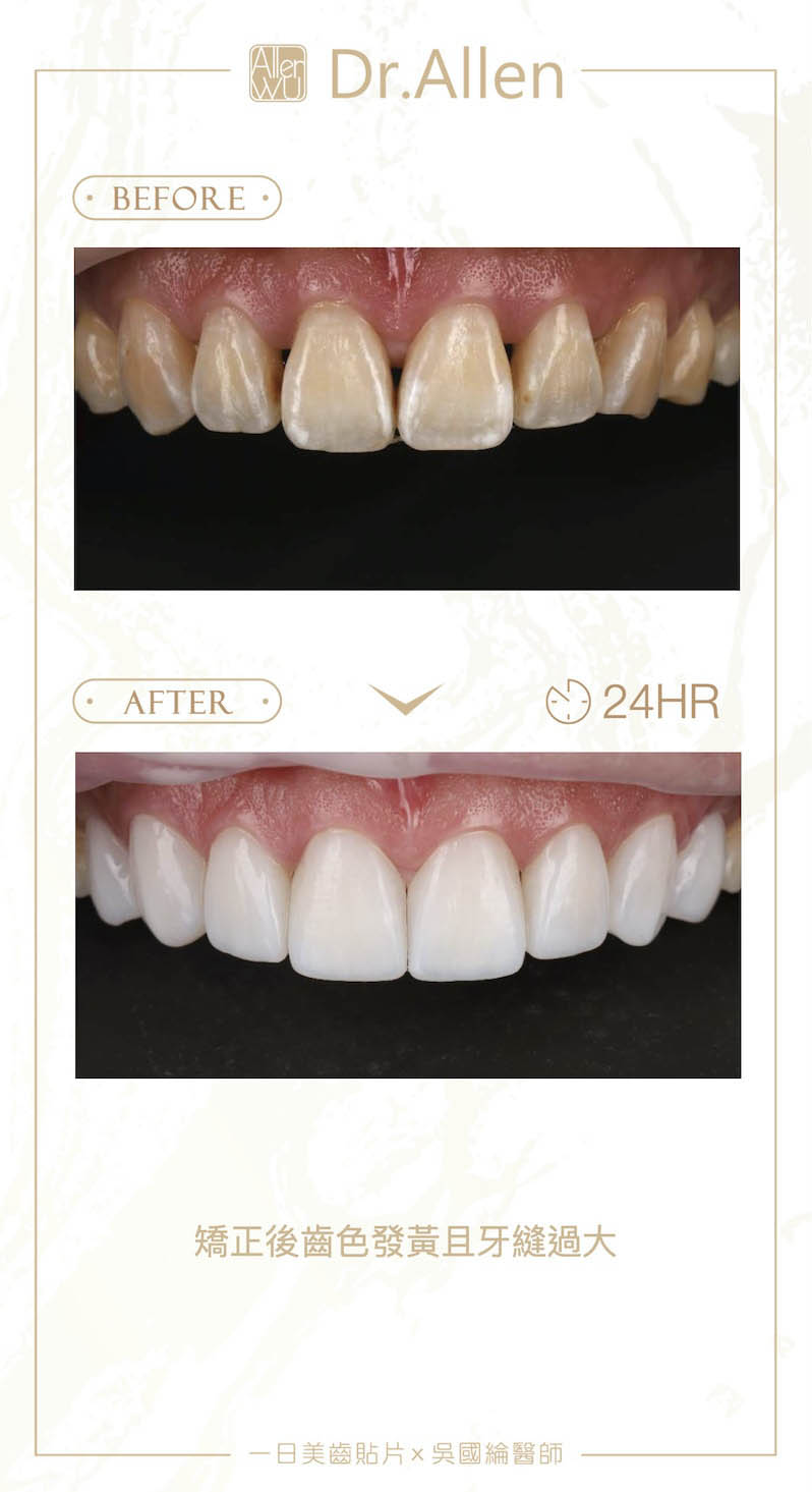 陶瓷貼片-矯正牙齒變黃-牙縫黑三角-陶瓷貼片前後對比-2-台中-吳國綸醫師