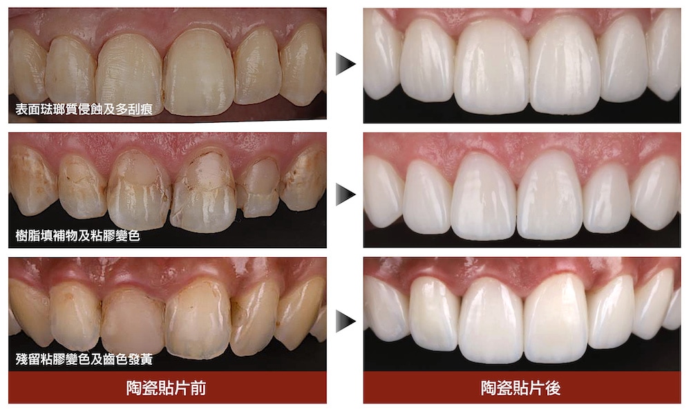 陶瓷貼片-矯正牙齒變黃-陶瓷貼片前後比較-台中-吳國綸醫師