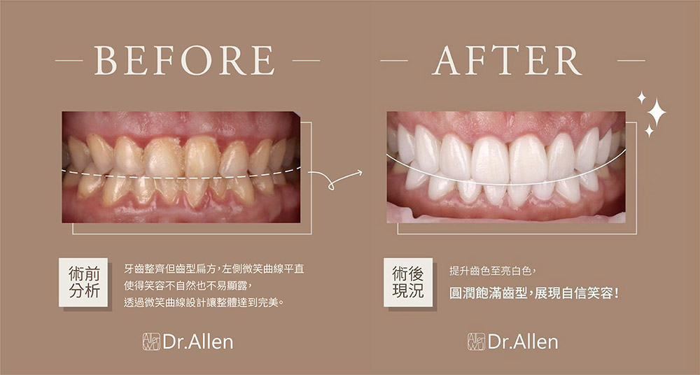 微笑曲線牙齒-陶瓷貼片前後比較-吳國綸醫師-台中-推薦-牙醫