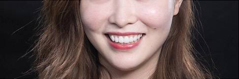 陶瓷貼片-DSD微笑設計模擬試戴笑容-微笑設計版本二-增強虎牙強化年輕形象-吳國綸醫師-台中