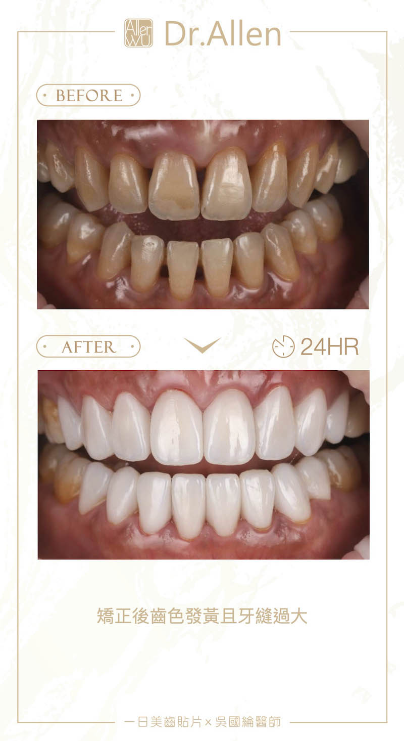 陶瓷貼片-矯正牙齒-牙套-牙齒黃-牙縫-黑三角-陶瓷貼片治療前後比較-1-台中-吳國綸醫師