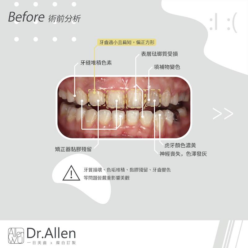 陶瓷貼片-矯正牙齒變黃-牙齒小-牙齒變色-陶瓷貼片療程前-吳國綸醫師-台中