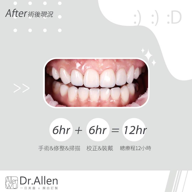 陶瓷貼片-矯正牙齒變黃-牙齒小-牙齒變色-陶瓷貼片療程後-吳國綸醫師-台中