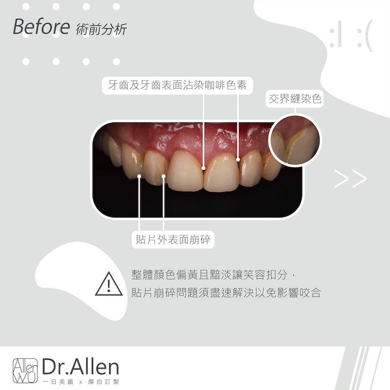 陶瓷貼片-舊牙齒貼片更換-牙齒染色-牙齒黃-陶瓷貼片療程前-吳國綸醫師-台中