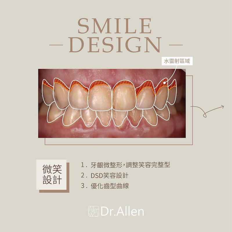 陶瓷貼片-牙齒小顆-水雷射-牙齦整形手術-調整牙齒形狀-治療中-吳國綸醫師-台中