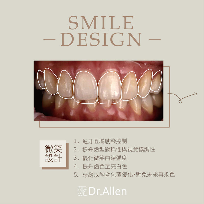 陶瓷貼片-牙齒黃-樹脂補門牙-門牙變色-微笑設計-吳國綸醫師-台中
