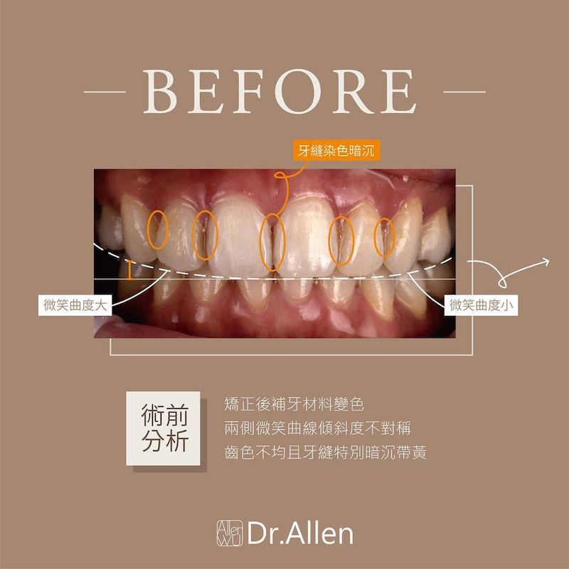 陶瓷貼片-牙齒黃-樹脂補門牙-門牙變色-治療前-吳國綸醫師-台中