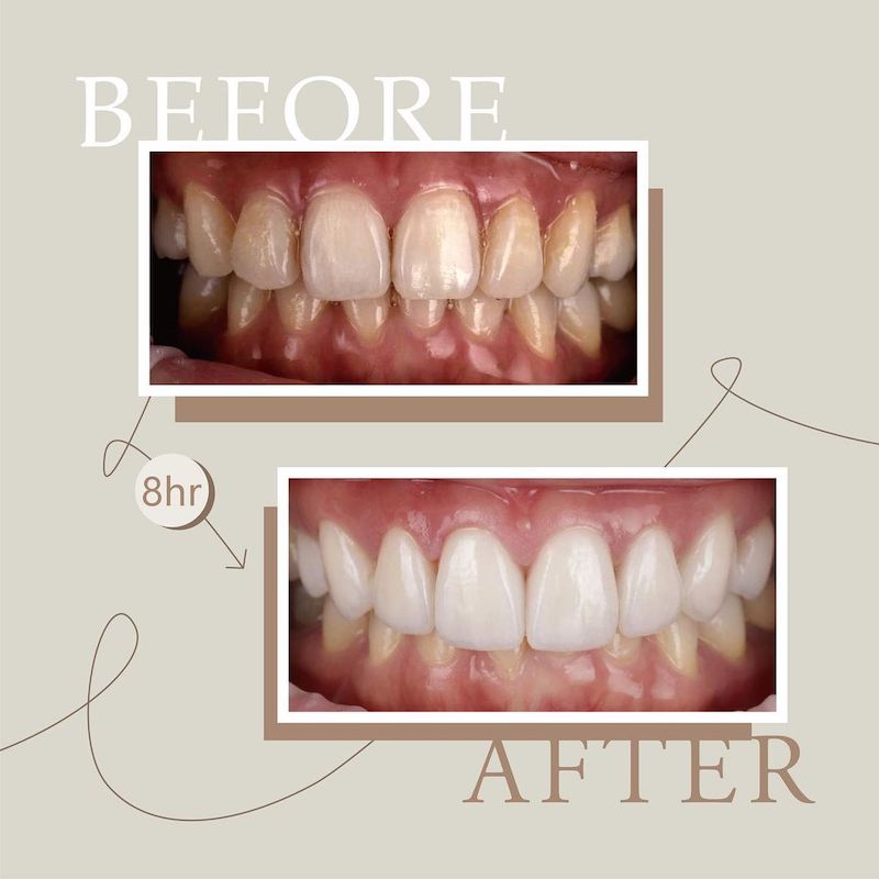 陶瓷貼片-牙齒黃-樹脂補門牙-門牙變色-治療前後對比-吳國綸醫師-台中