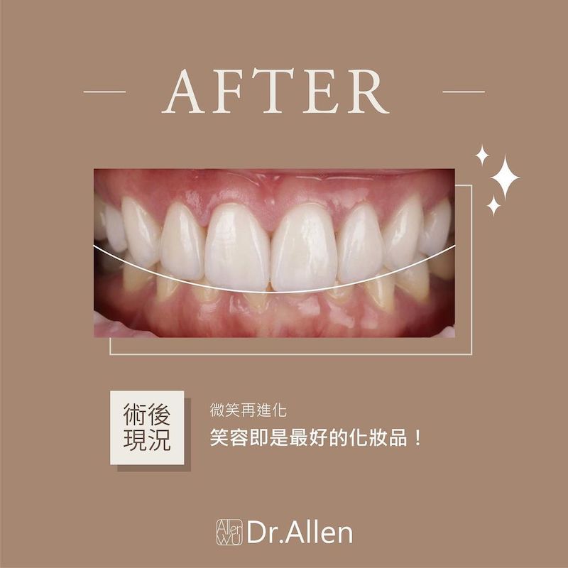 陶瓷貼片-牙齒黃-樹脂補門牙-門牙變色-治療後-吳國綸醫師-台中