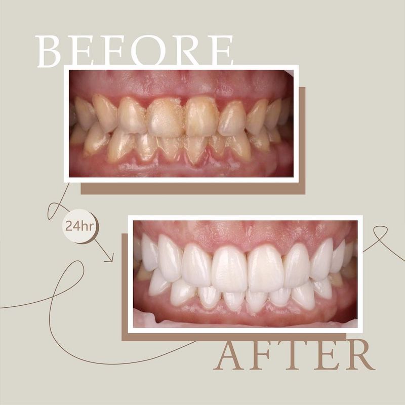 陶瓷貼片-牙齒黃-牙齒小顆-水雷射-牙齦整形手術-治療前後對比-吳國綸醫師-台中