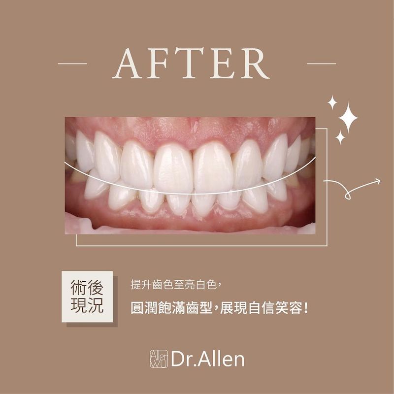 陶瓷貼片-牙齒黃-牙齒小顆-水雷射-牙齦整形手術-治療後-吳國綸醫師-台中