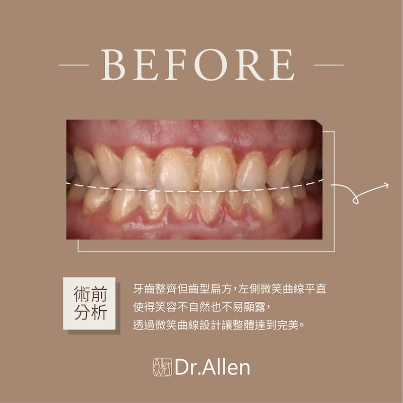 陶瓷貼片-牙齒黃-牙齒小顆-治療前-吳國綸醫師-台中