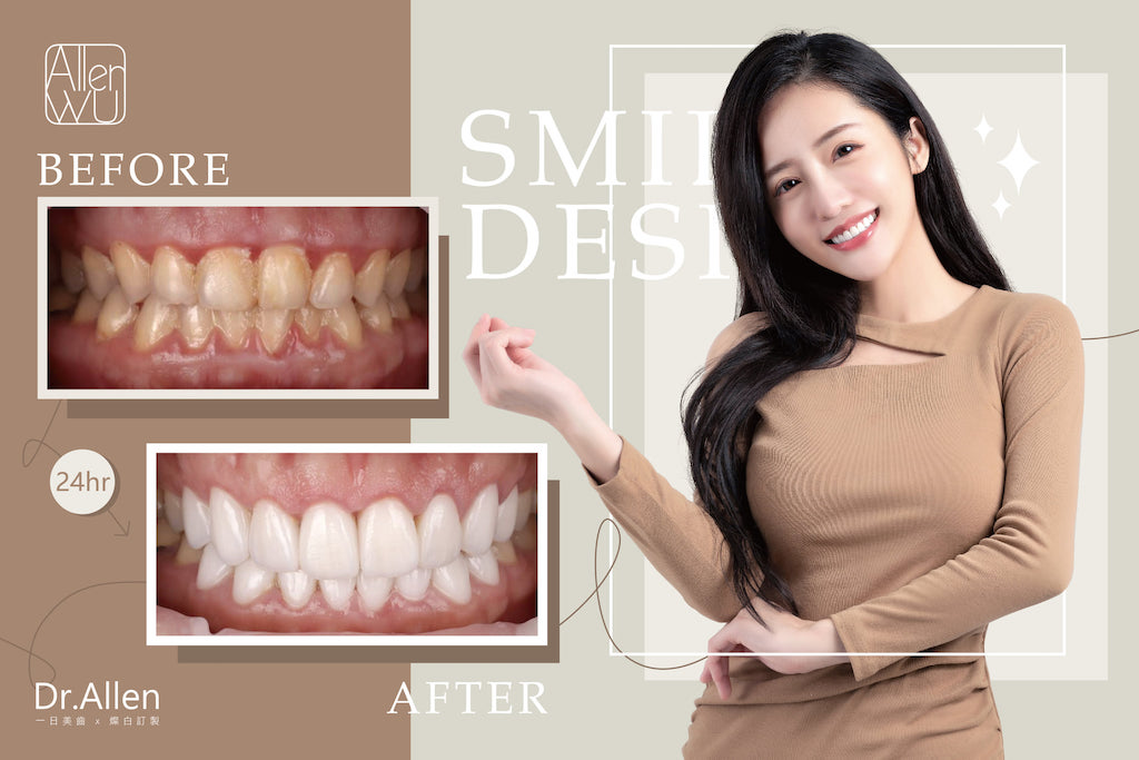 陶瓷貼片-牙齒黃-牙齒小顆-牙齦整形-微笑設計-吳國綸醫師