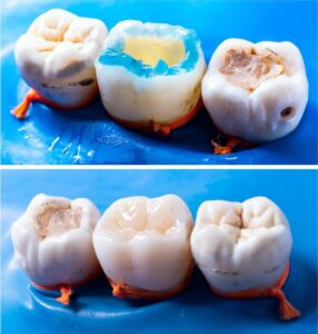 3D齒雕-陶瓷嵌體-治療前後比較圖